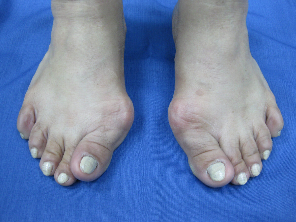 Hallux valgus antes de la cirugía percutánea