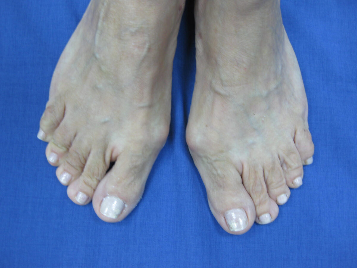 Hallux valgus antes de la cirugía percutánea
