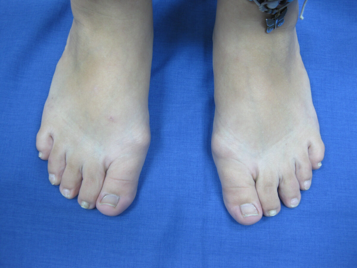 Hallux valgus antes de la cirugía percutánea