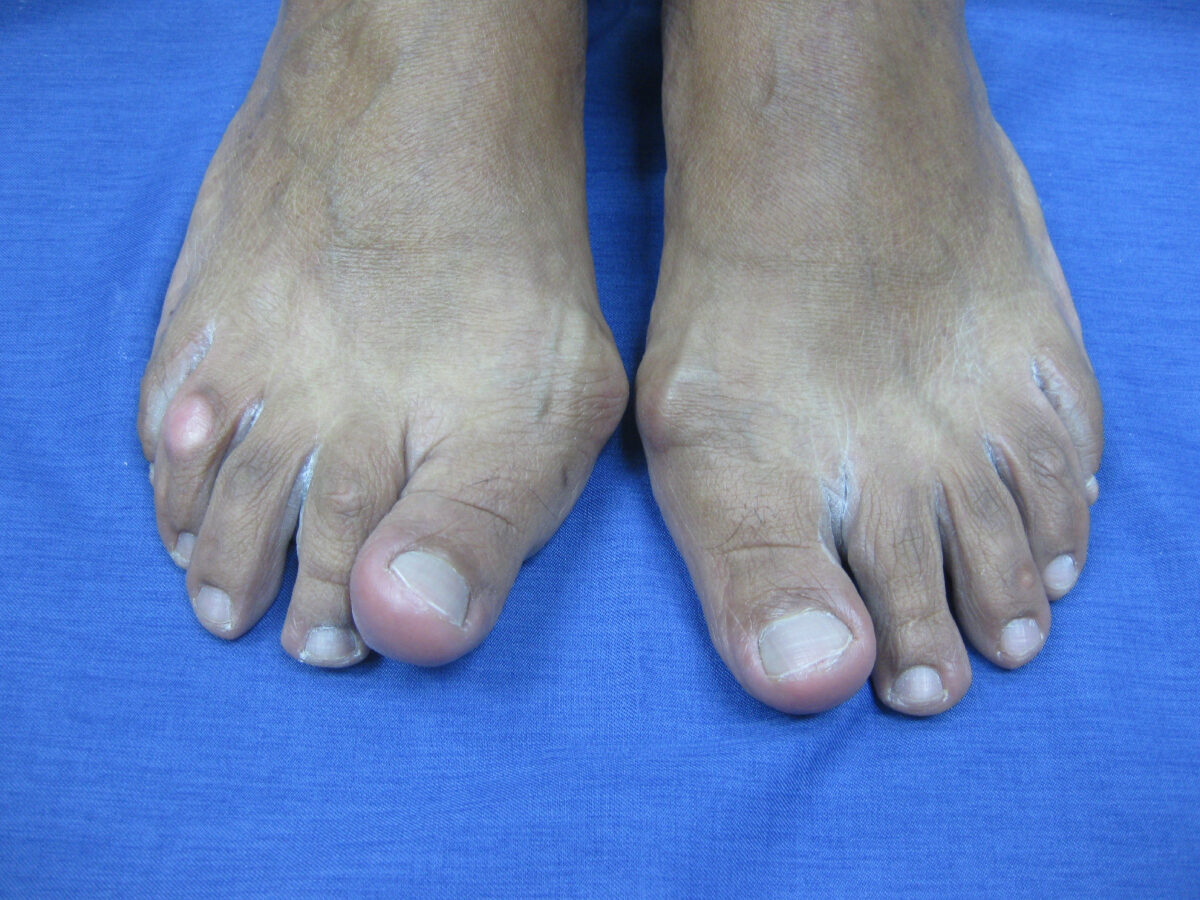 Hallux valgus antes de la cirugía percutánea