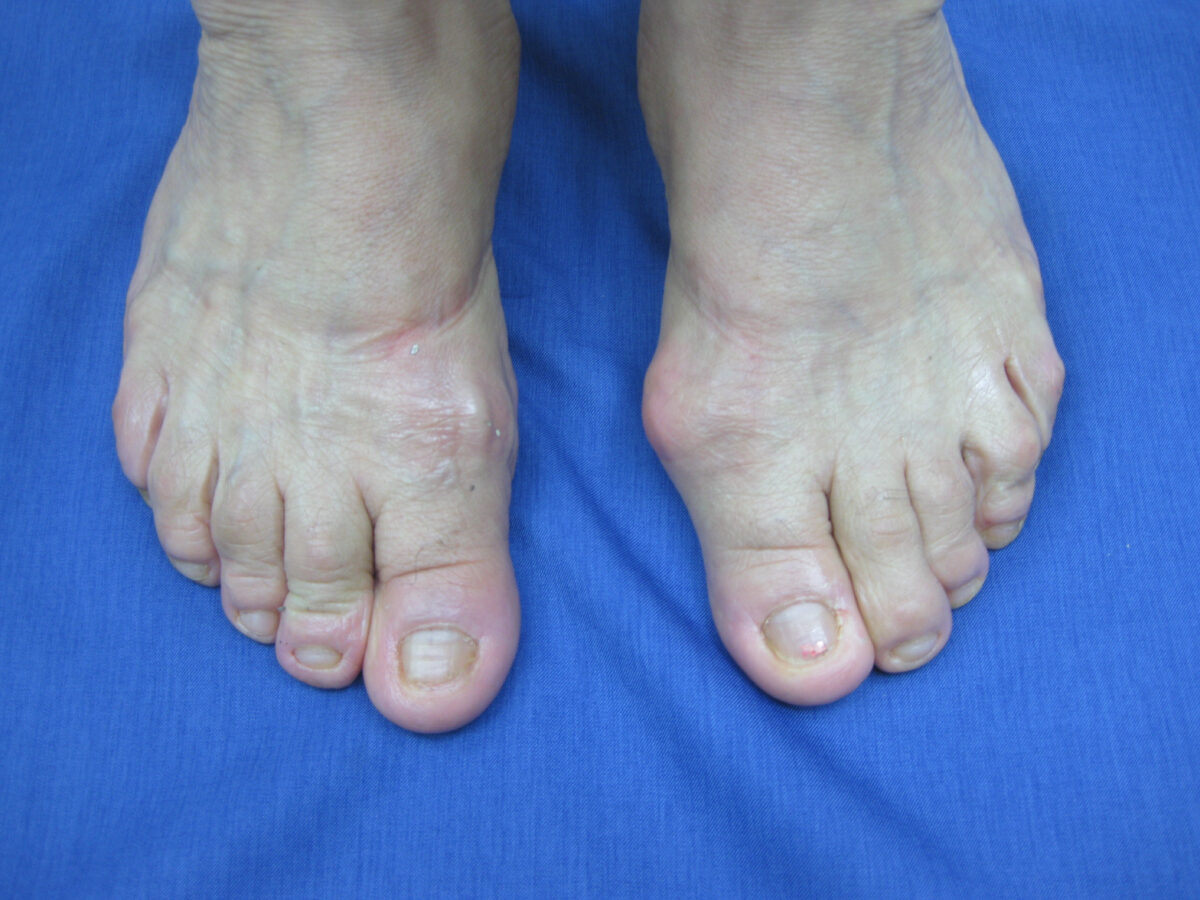Hallux valgus antes de la cirugía percutánea