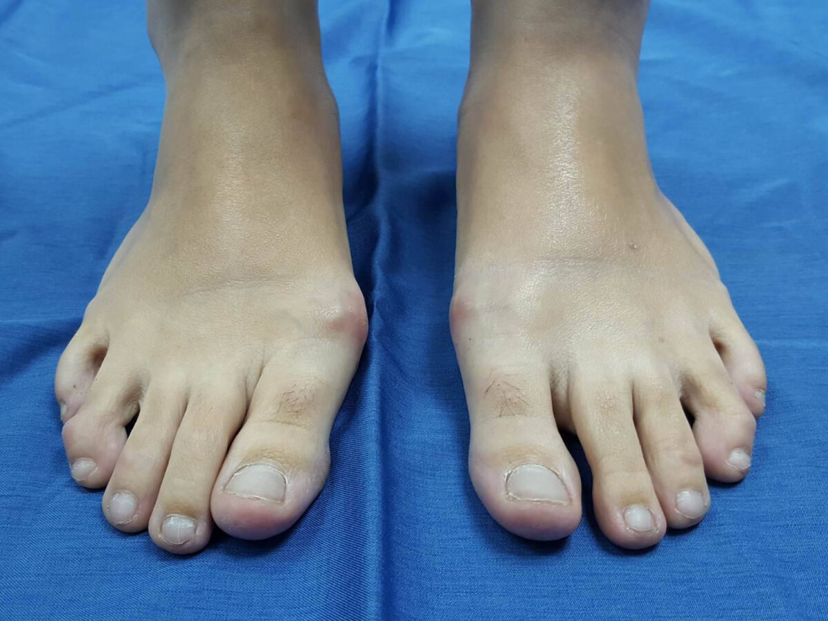 Hallux valgus antes de la cirugía percutánea