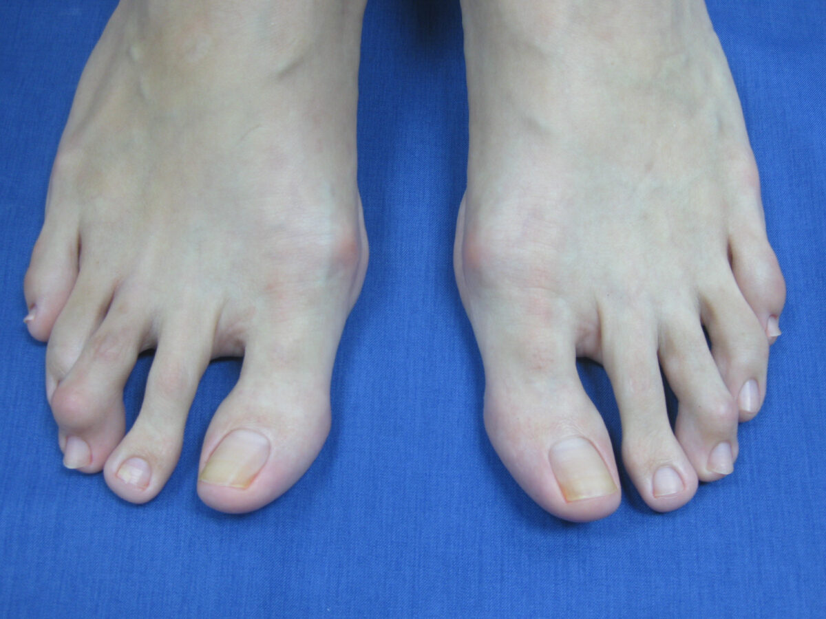 Hallux valgus antes de la cirugía percutánea