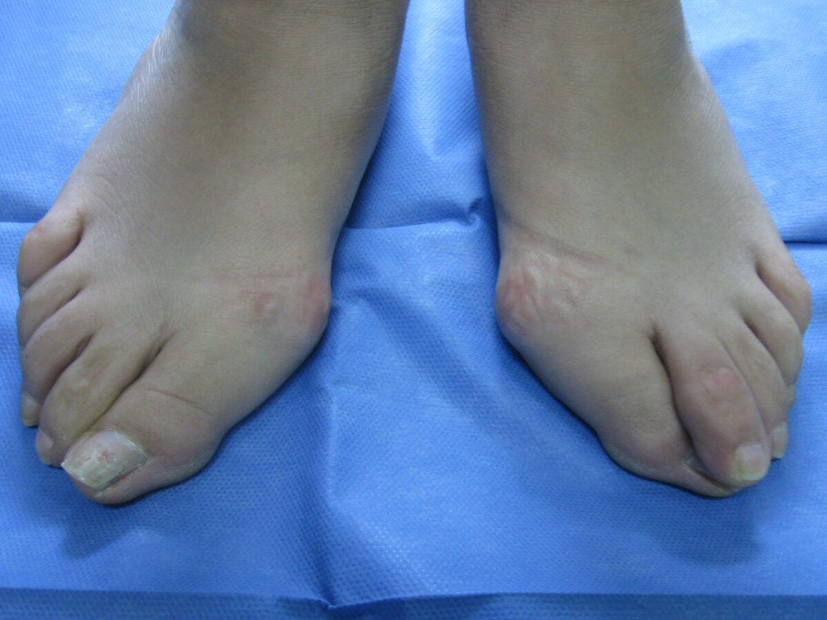 Hallux valgus antes de la cirugía percutánea