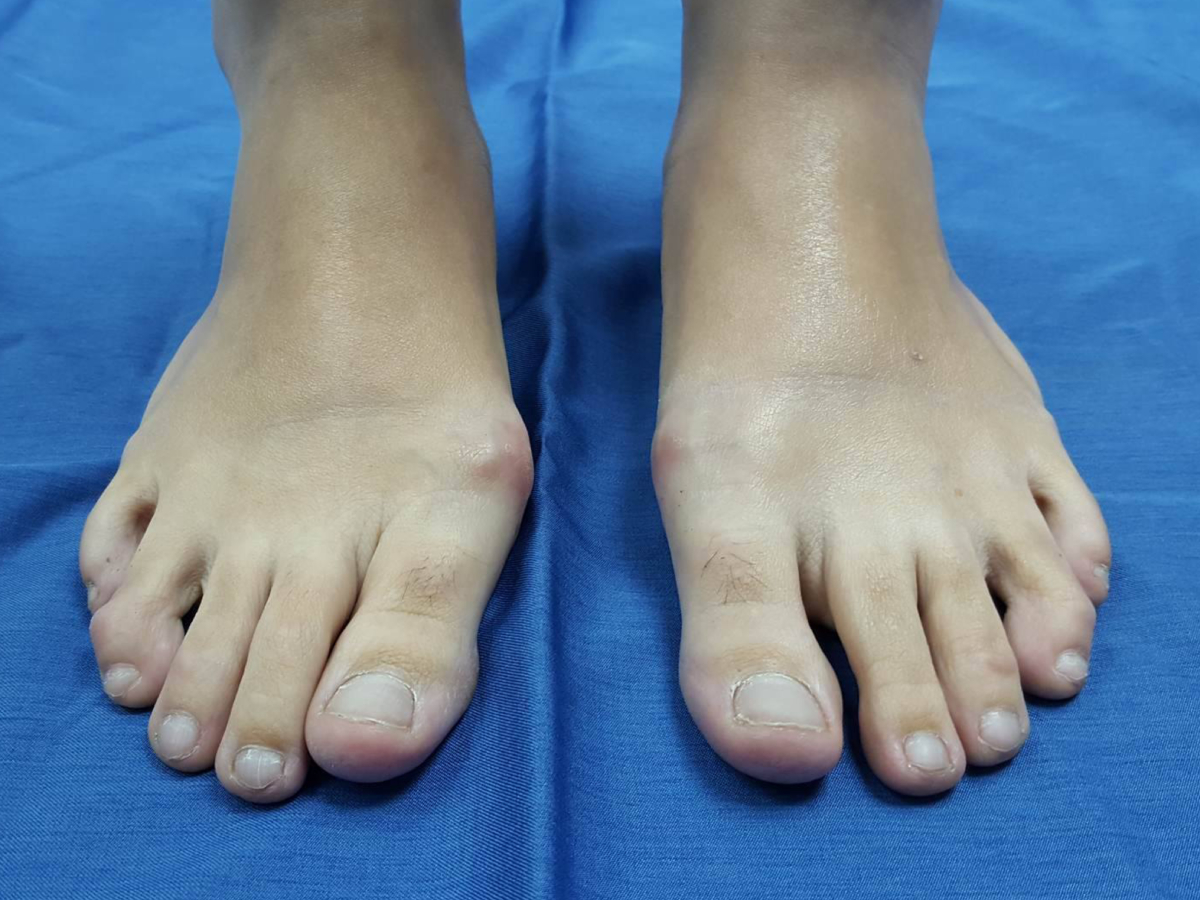 Antes cirugía de juanetes, Hallux Valgus bilateral