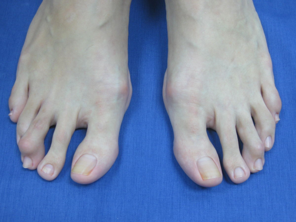 Antes cirugía de juanetes, Hallux Valgus